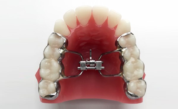 Rapid Palatal Expansion with the Keles Keyless Expander