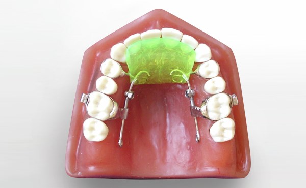 The Keles Slider Appliance for Bilateral and Unilateral Maxillary Molar Distalization